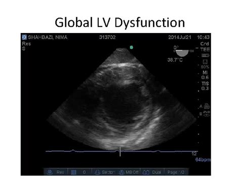 global lv|global lv dysfunction.